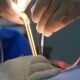 Appendicitis